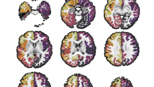  New Orygen research answers critical question about brain changes in people with psychosis